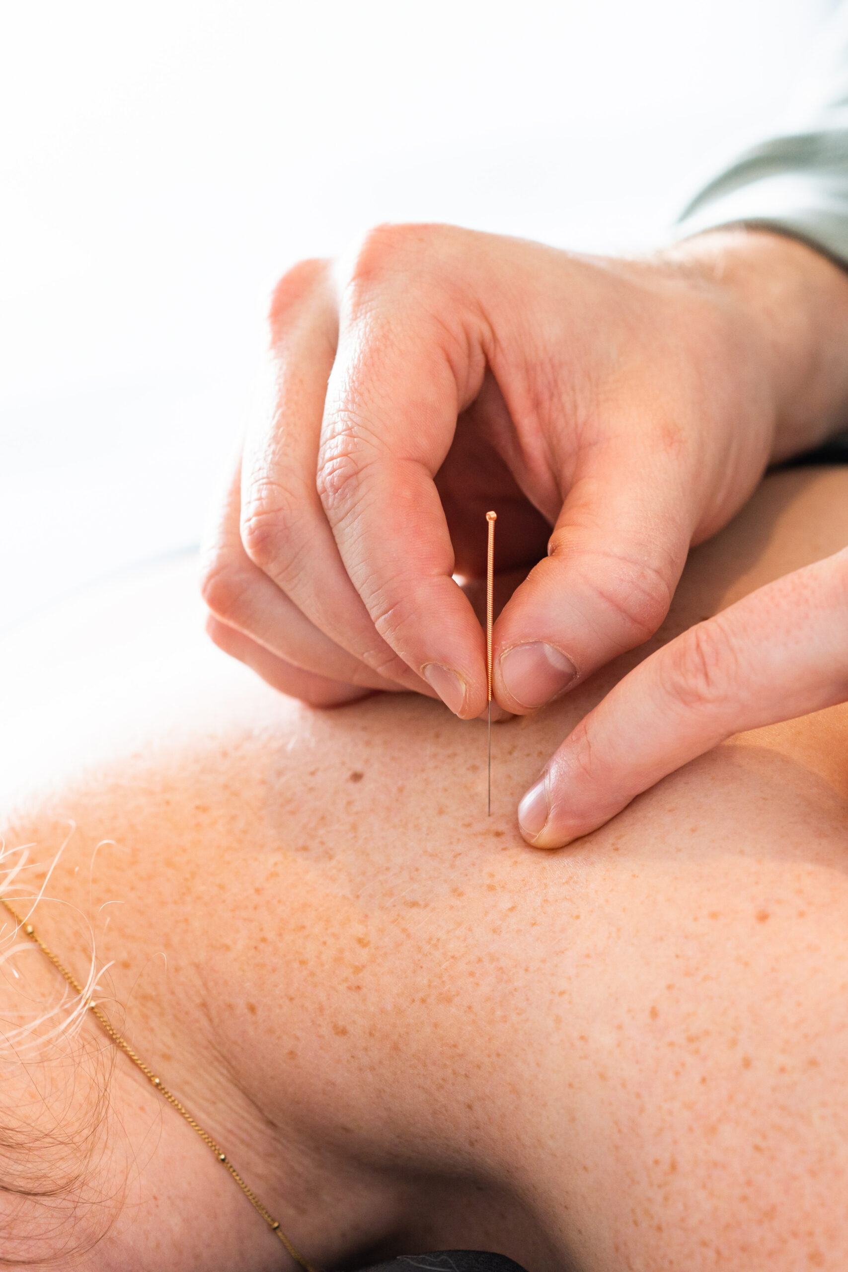 dry needling